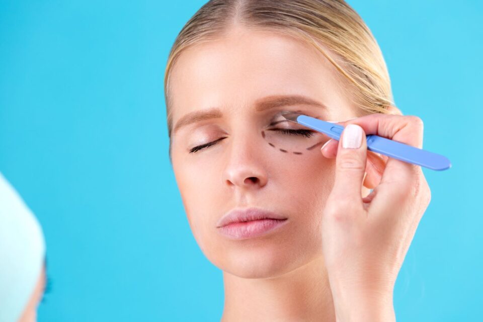 Woman preparing for eyelid surgery with markings in East Stroudsburg, PA